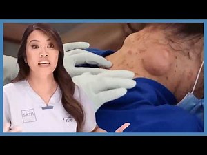 Dr. Lee Fixes Patient’s Dangerous DIY Cyst Extractions | Dr. Pimple Popper | Love Medical