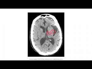 Cerebrovascular Disease for the USMLE Step 1