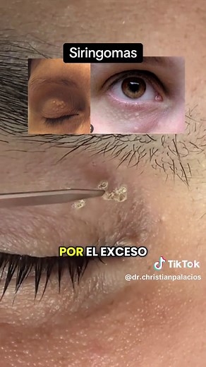 ¿Bolitas en los párpados? #siringomas #dermatologia #dermatologo #laser #medicina