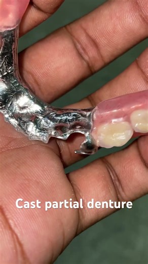 Cast partial denture 😬😬😬#apexdental #orthodontist #partialdenture #completedenture #dentistry