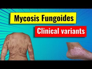 Clinical variants of Mycosis fungoides (MF)