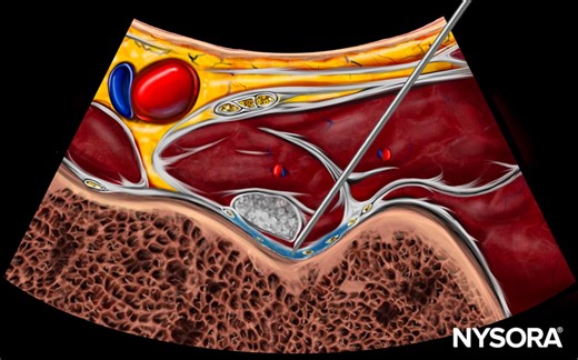 5.6K views · 49 reactions | New in the NYSORA Nerve Blocks App!...