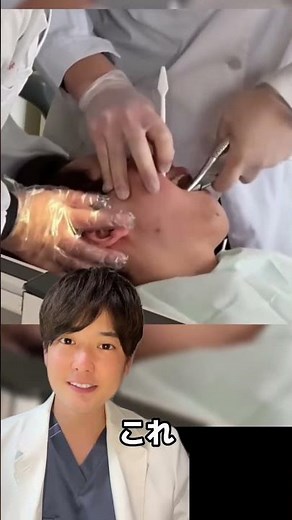 歯の抜き方について説明します #歯医者 #おすすめ #抜歯