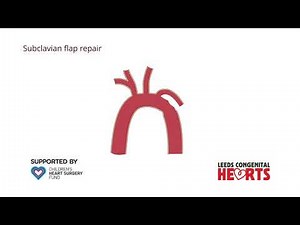 Coarctation of the Aorta: treatment