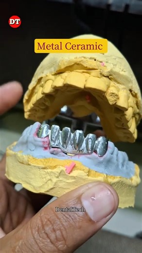 metal Ceramic bridge| dental technician| anterior Ceramic| porcelain| posterior • build up video