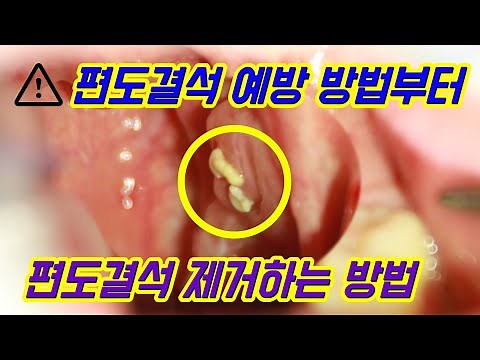 입냄새원인!편도결석 원인과 예방 편도결석 제거,치료방법 [하나이비인후과병원]