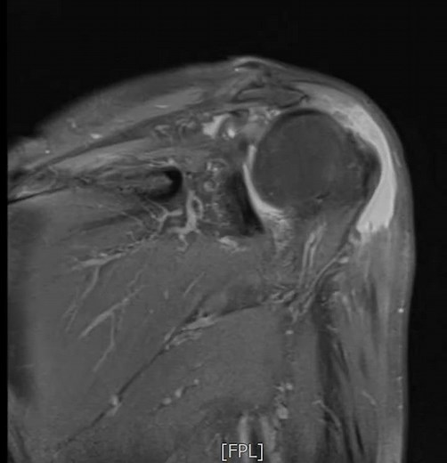 Deltoid muscle complete tear