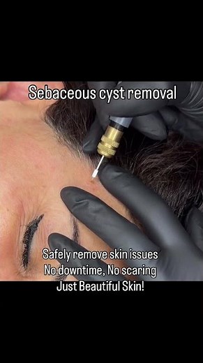 Sebaceous Cyst Removal | Smooth, Clear, Healthy Skin #SkinHealth, #CystRemoval, #CharlotteBeauty