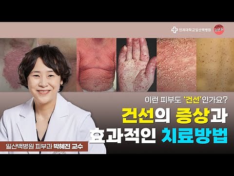 이런 피부도 건선인가요?│건선의 증상과 효과적인 치료방법│일산백병원 피부과 박혜진 교수