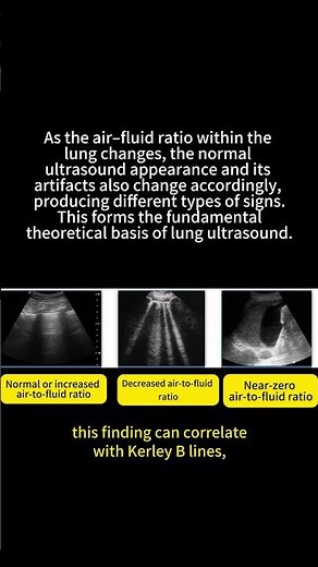 B-Lines in Lung Ultrasound – Quick Guide #ultrasound #sonography #sonographer
