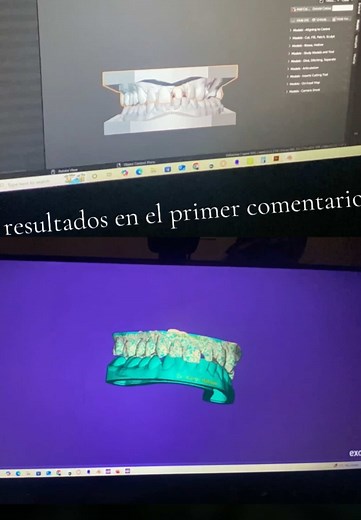 Blender for Dental vs Exocad: ¿Cuál Prefieres?