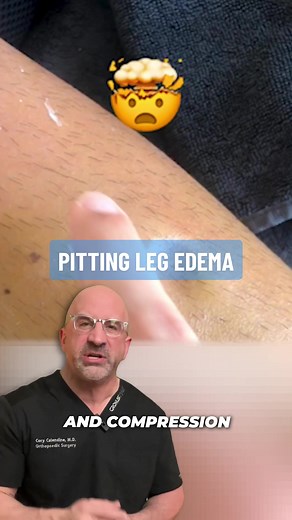 Pitting Edema after Knee Surgery 🔨 Swelling is a common complaint in the first few weeks after knee replacement. The swelling is normal and is usually moderate to severe in the 1st week but gradually decreases for the next weeks and months. Mild swelling may persist normally as long as 6 mos in some patients. In the case of the knee after replacement (and other lower extremity surgeries), swelling occurs as a result of the accumulation of excess fluid in the tissue of the knee joint. During sur