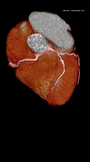 Proses Angiogram dan Penempatan Stent Jantung