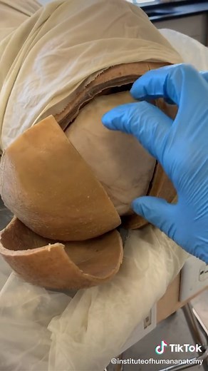 The Fascinating Practice of Trepanning: Drilling Holes in the Head for Cognitive Improvement