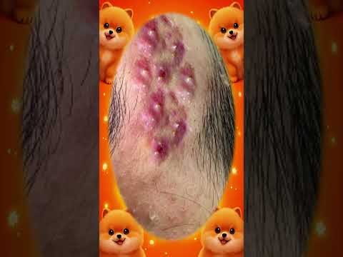 Blackheads Removal #619 | Acne Treatment and Very Satisfying Satisfying Pimple pop #blackheads
