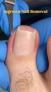 64K views · 697 reactions | Deep ingrown nail removal done safely and professionally. Immediate pressure relief, reduced swelling, and proper care to help prevent future ingrowns. This is corrective care, not just cosmetic. #deepingrownnail #ingrownnailremoval #ingrownnail #toenailcare #footcare #nailhealth #painrelief #medicalpedicure #professionalfootcare #beforeandafter #satisfying #oddlysatisfying #reelsinstagram | Podiatrist-SJ | Facebook