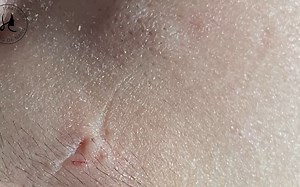 Huong Da Nang Acne Treatment #351