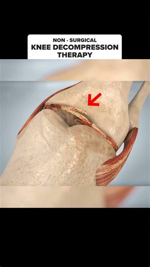 Knee Pain Isn't Permanent! 😲 How Knee Decompression Therapy Reduces Joint Pressure #Shorts #kneepain