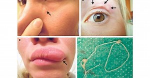 Moving lump on woman’s face turns out to be parasitic worm