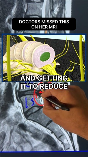 Spinal Decompression Reduced Her L4‑L5 Herniation Surgery-Free #DiscHerniation #BackPainRelief