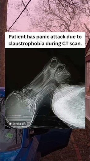 Patient has panic attack due to claustrophobia during CT scan