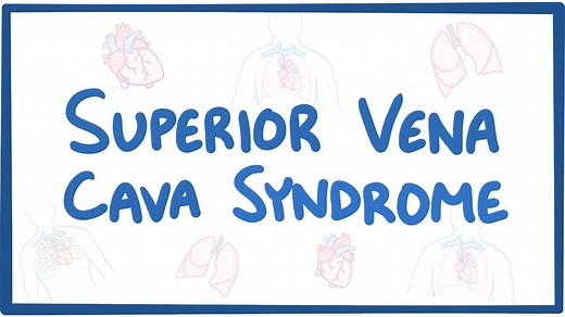 Superior vena cava syndrome: Video, Causes, & Meaning | Osmosis