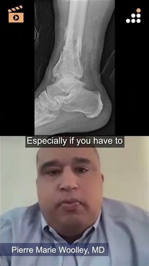 Staged External Fixation to Protect Soft Tissue in Open Pilon Fractures