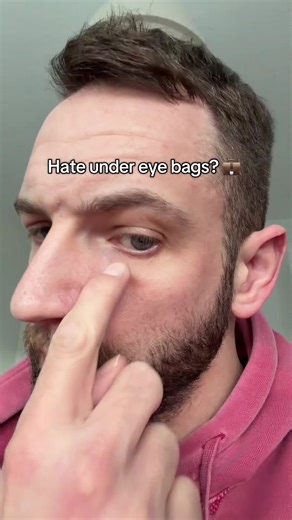 Under Eye Bags Treatment – Quick Fix in 5 Minutes