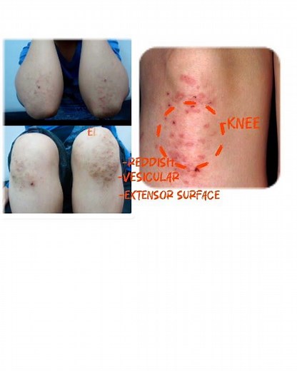 Dermatitis Herpetiformis - Dermatology