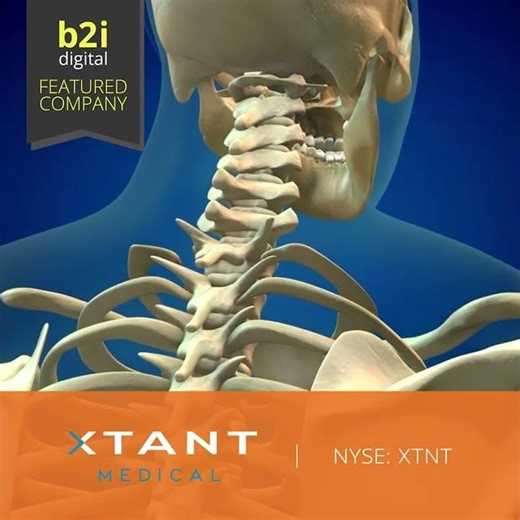 Xtant Medical Holdings (NYSE-American: XTNT) announced the commercial launch of nanOss Strata™,