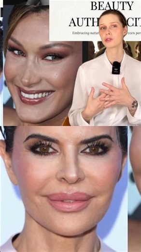 Frozen Face Isn't The Look #beautystandards #botox #fyp