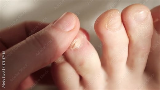 Damaged toenail closeup slow motion video. Onycholysis is a common nail disorder. Causes of onycholysis include trauma, skin disease, and nail infections. Podiatry treatment to follow.