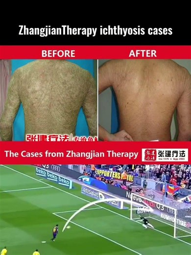 Ichthyosis treatment cases of Zhangjian Therapy #ichthyosisvulgaris #ichthyosis#dryskin