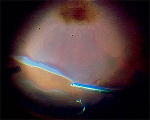 Managing a Giant Retinal Tear