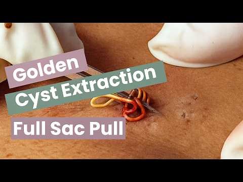 GIANT Golden Cyst Removal ASMR — Satisfying Deep Extraction with Complete Sac Pull | Pimple Spa