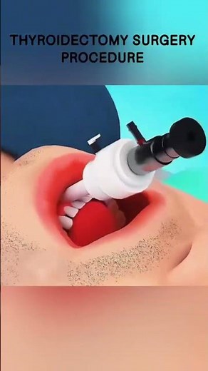 THYROIDECTOMY SURGERY PROCEDURE