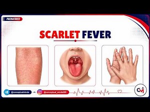 85. Scarlet Fever Explained | Causes, Clinical Features, Diagnosis & Management | Pediatrics