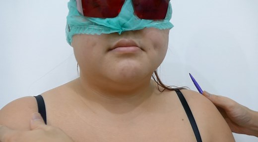 Patient No. 150 to 199 - L’Élixir de Vie, by Arthur Tjandra (曾华浚), M.D., FICS (Plastic Surgery)