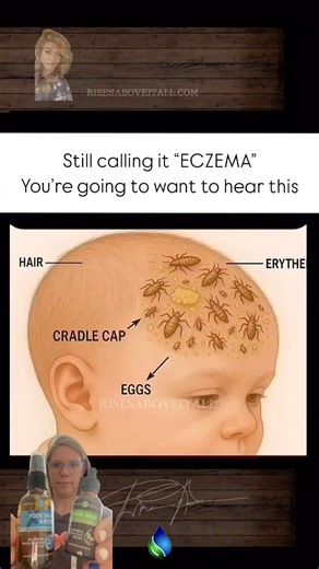 💥PARASITES, CANDIDA & CRADLE CAP: THE HIDDEN CONNECTION NO ONE TALKS ABOUT Did you know that parasites are behind the biofilm and candida overgrowth so many people (and babies) are struggling with? These invaders don’t just “pass through.” They set up camp in your body — and they’re smart. They create a protective slime layer called biofilm, which shields them from your immune system and allows fungus like candida to thrive alongside them. And here’s where it gets even more real: 🧠 This biofil
