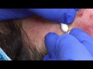New Enilsa Brown blackhead video!