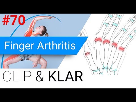 Finger arthritis explained - Rheumatoid arthritis, psoriasis and more.