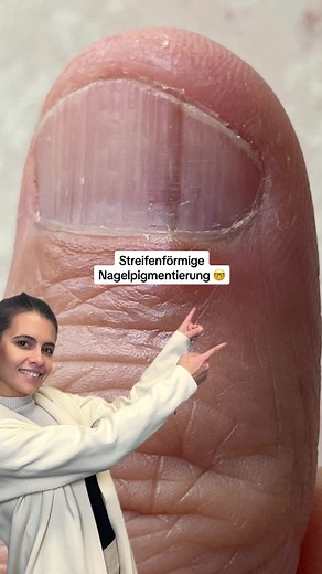 Melanonychia longitudinalis: Ursachen, Symptome und Behandlungen