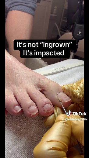 Do you know the difference between ingrown verses impacted or involuted? #tiktoklive #livehighlights #nailtech #naileducator