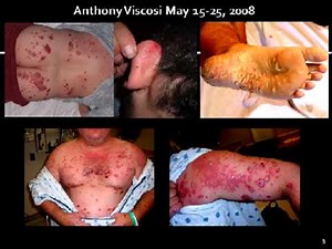 Stelara Side Effects / Stelara causes drug induced psoriasis / Biologic problems