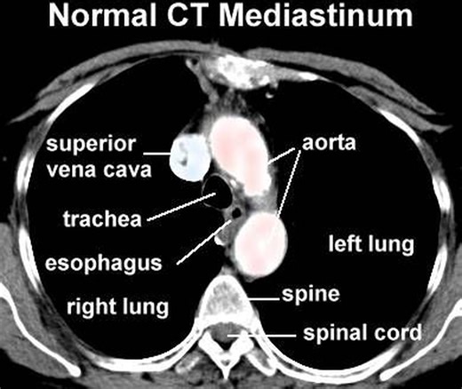 #slice #ct #anatomy #CTScan #aorta | CT Scan and MRI study