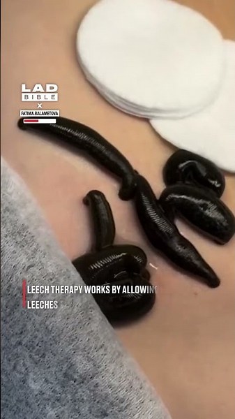 Treating my acne with leech therapy 😳😱