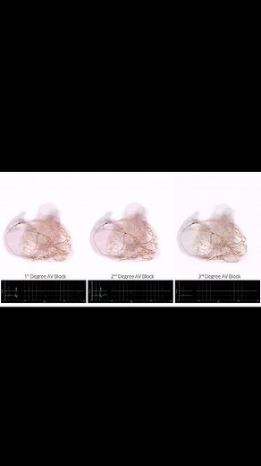 4.6K views · 12 reactions | Understanding Heart Block: First-Degree...