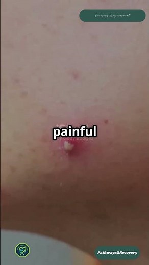 Fighting Folliculitis I Uncovering the Truth Behind Skin Inflammation