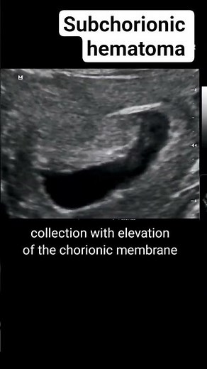 Subchorionic hematoma on ultrasound #radiology #pregnant #ultrasound #pregnancyscan #baby