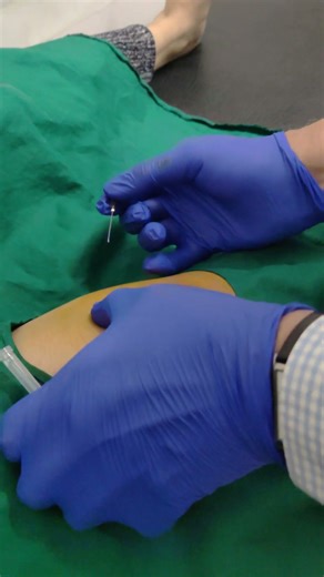 correction of knee varus deformity by pie crusting technique without surgery